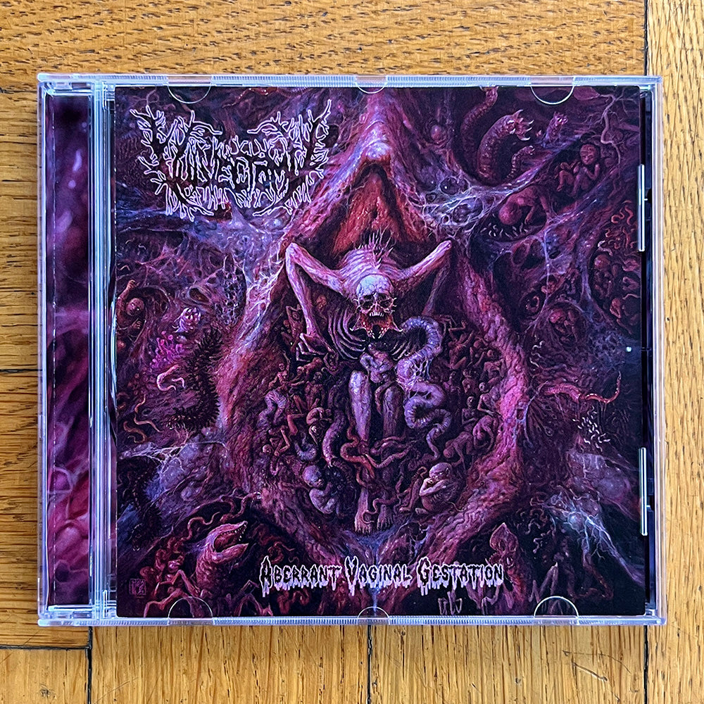 Vulvectomy "Aberrant Vaginal Gestation" CD